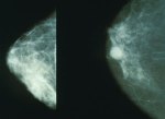 Normal and abnormal mammograms